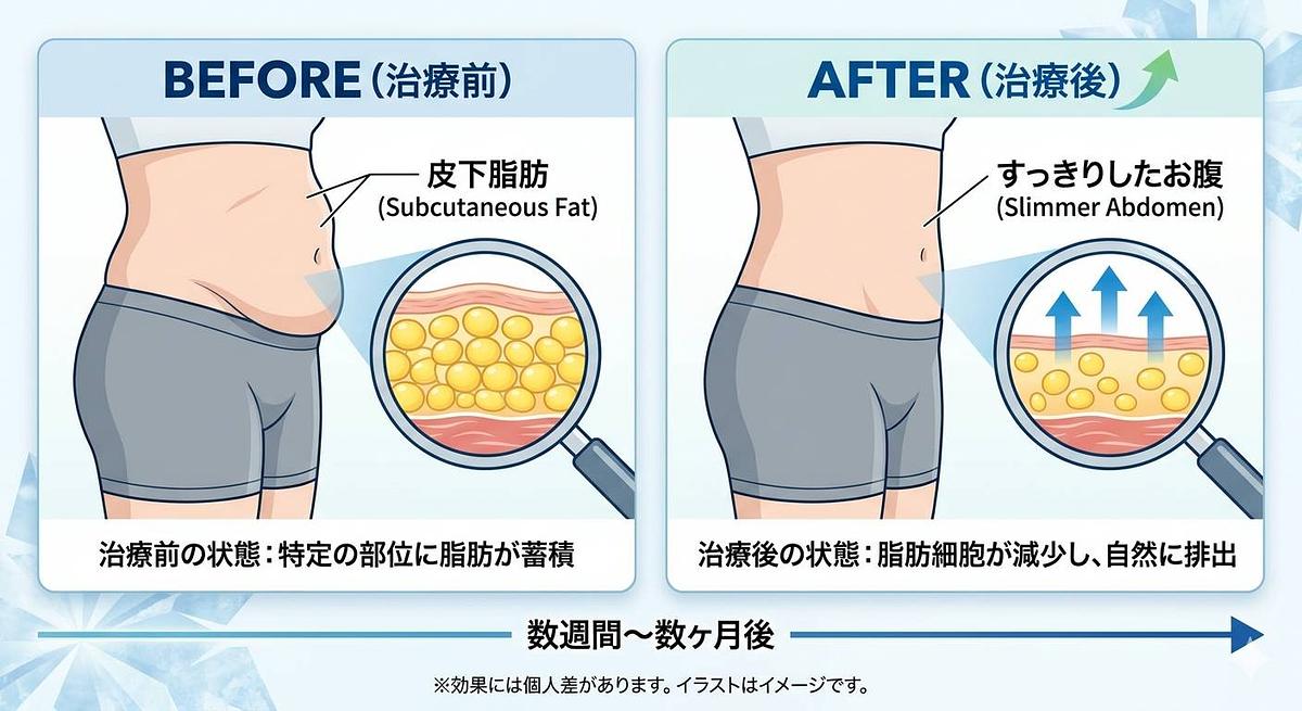 脂肪冷却