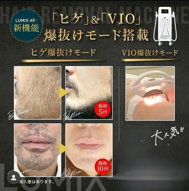 ひげ脱毛